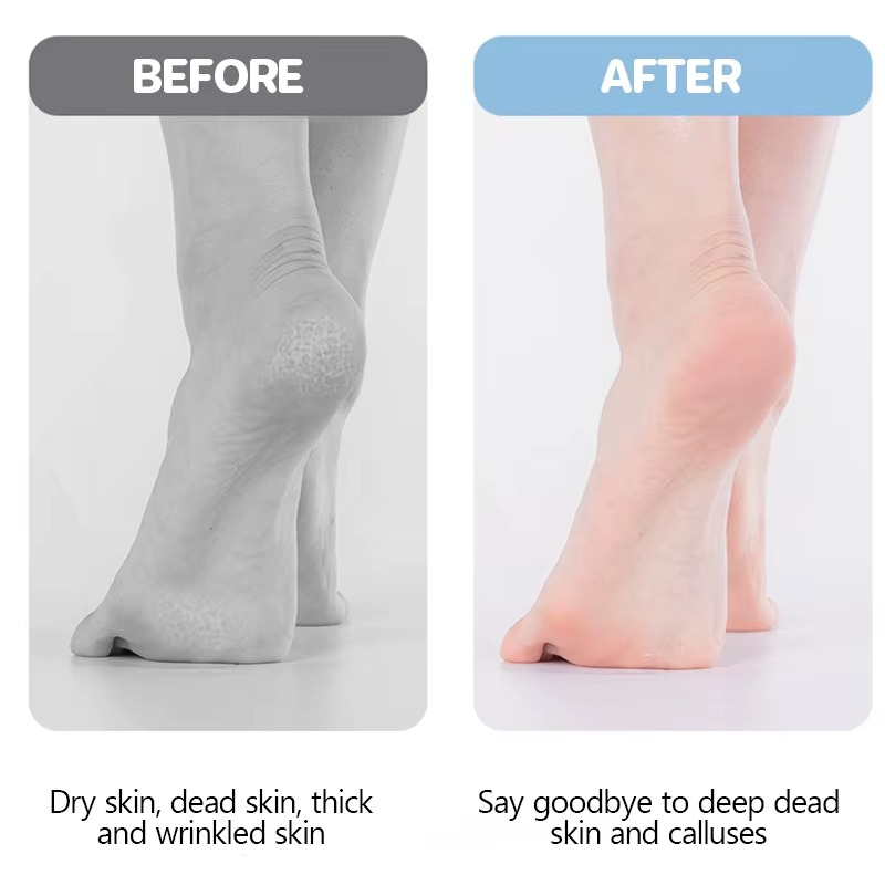 Elektricna turpija za pete